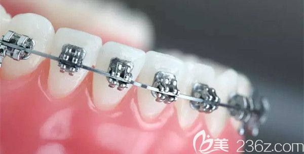 自鎖托槽的圖片 自鎖托槽的圖片