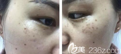 激光祛斑第7天臉上痂已經(jīng)脫落