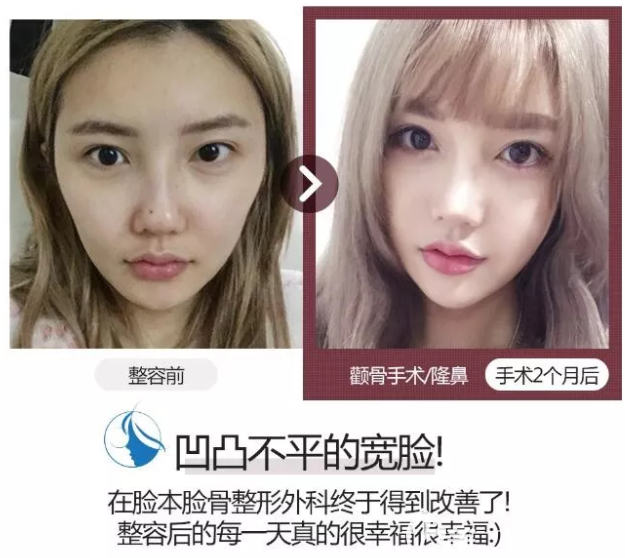 樸用南院長(zhǎng)輪廓真人案例 樸用南院長(zhǎng)輪廓真人案例