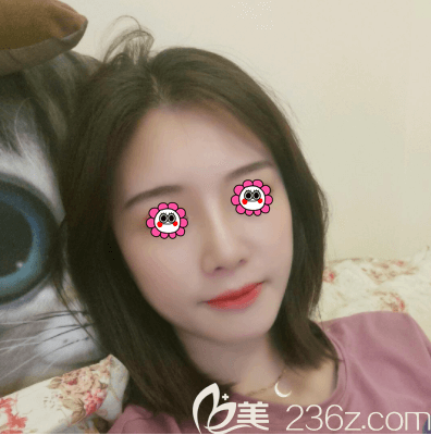 北京壹加壹張曉亮肋軟骨隆鼻案例