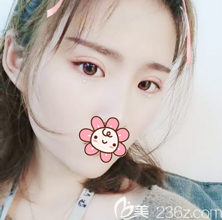 深圳麗港麗格劉虎做的雙眼皮案例 深圳麗港麗格劉虎做的雙眼皮案例