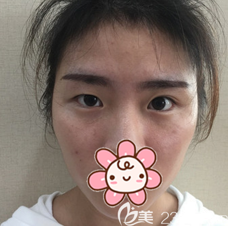 來深圳麗港麗格割雙眼皮前的照片 來深圳麗港麗格割雙眼皮前的照片