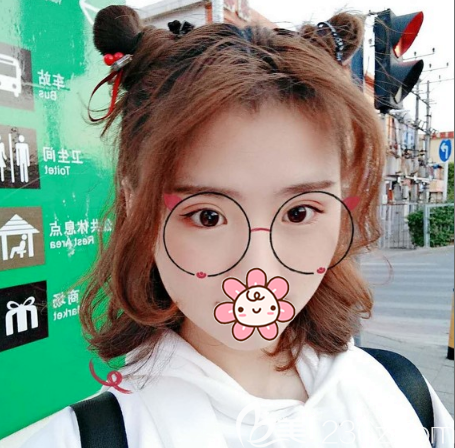 全切雙眼皮術(shù)后20天的效果 全切雙眼皮術(shù)后20天的效果