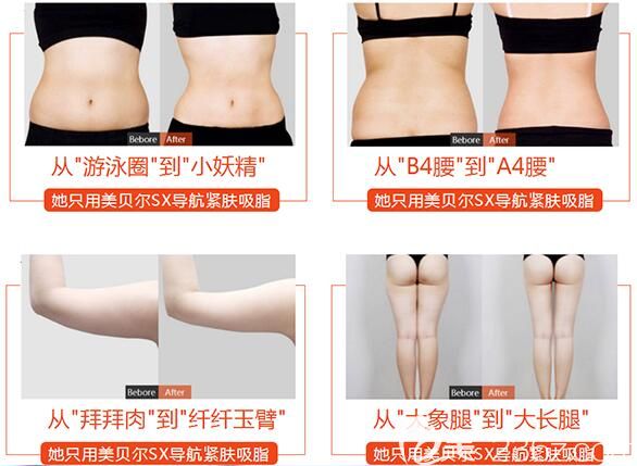 揚州美貝爾SX導(dǎo)航吸脂案例對比