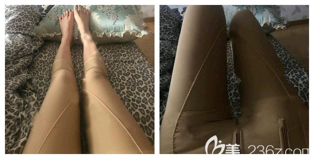 做完大腿吸脂術(shù)后三天穿著塑身衣