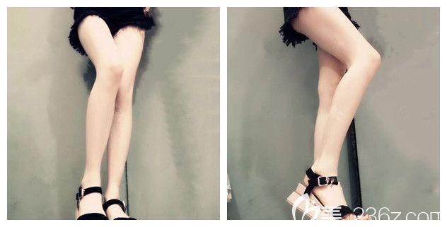 揚(yáng)州美貝爾SX導(dǎo)航吸脂是技術(shù)噱頭包裝嗎?看過原理、案例、反饋后面診醫(yī)生做了大腿吸脂抽了1500ml脂肪