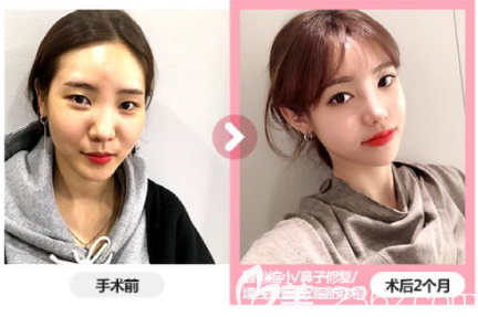 公開我在韓國臉本臉骨整形外科樸用南做顴骨鼻子修復(fù)脂肪移植價格