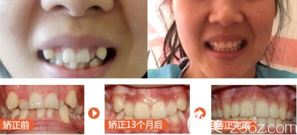 美萊口腔怎么樣？特呈上顧客真人矯正案例