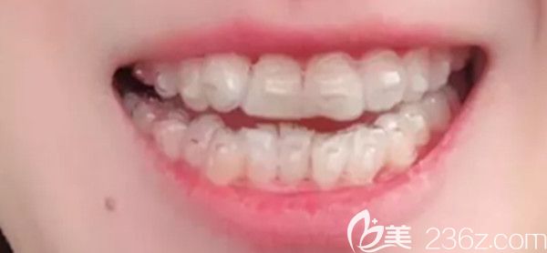 戴牙套的第六個月，牙齒變得整齊了