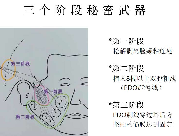 樸明旭院長分階段埋線提升示意圖 樸明旭院長分階段埋線提升示意圖