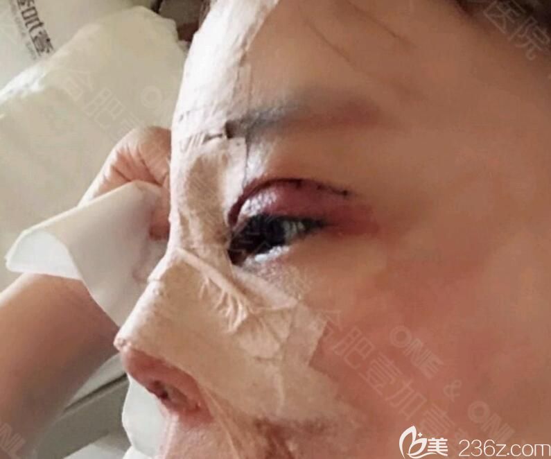 <!--<i data=20240703-sp></i>-->院長做膨體軟骨隆鼻+眼綜合術(shù)后第1天