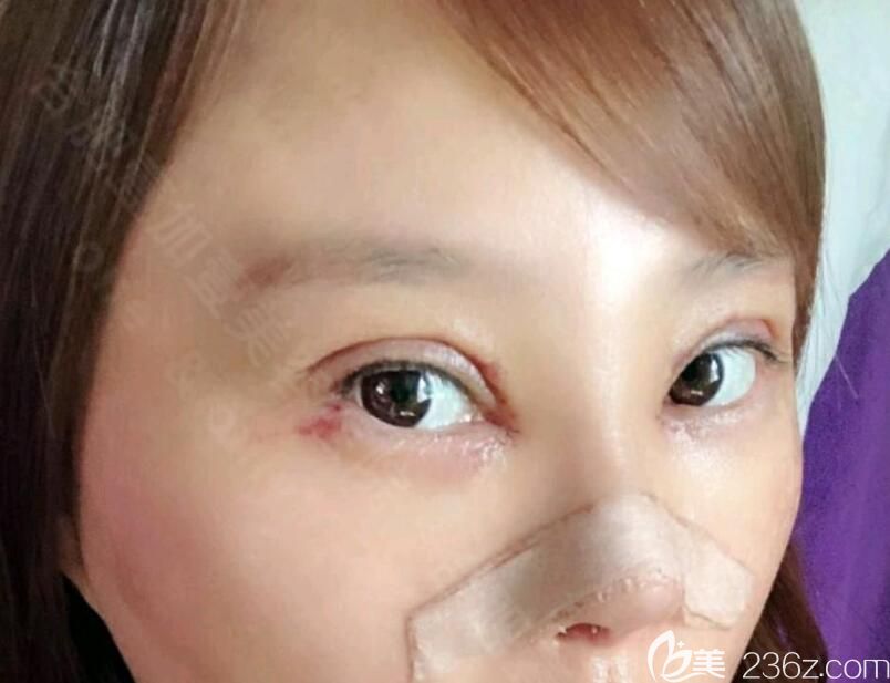 壹加壹整形眼鼻綜合術(shù)后第10天