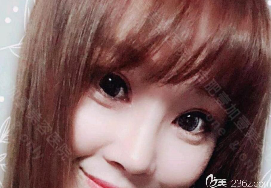 隆鼻失敗修復(fù)+眼綜合術(shù)后第25天恢復(fù)情況