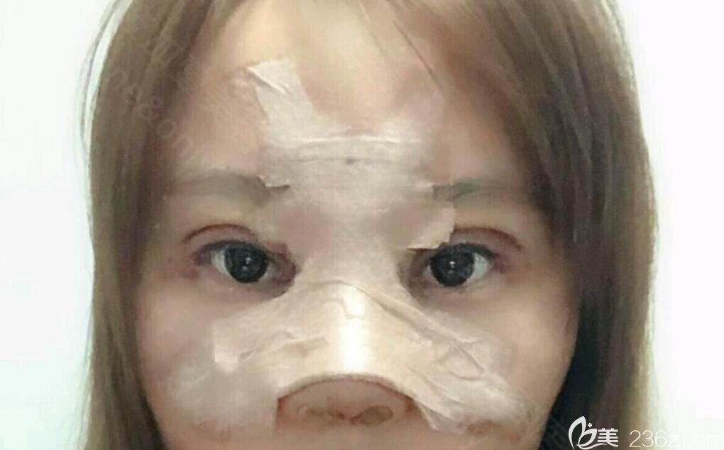 合肥壹加壹隆鼻失敗修復(fù)+眼綜合術(shù)后第7天