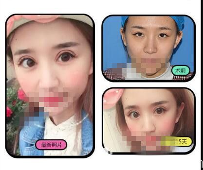 洛陽毛大夫雙眼皮前后對比照片