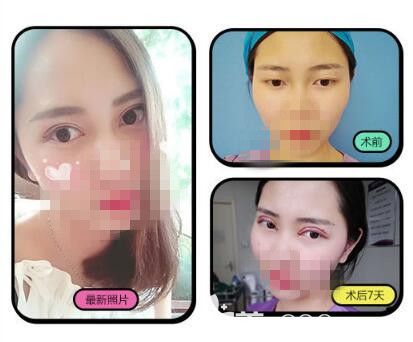 洛陽毛大夫雙眼皮前后對比照片