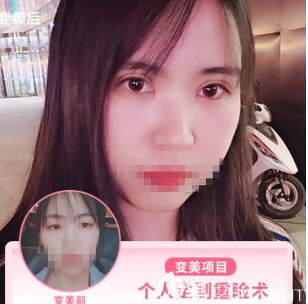 普瀟醫(yī)生做的眼部整形