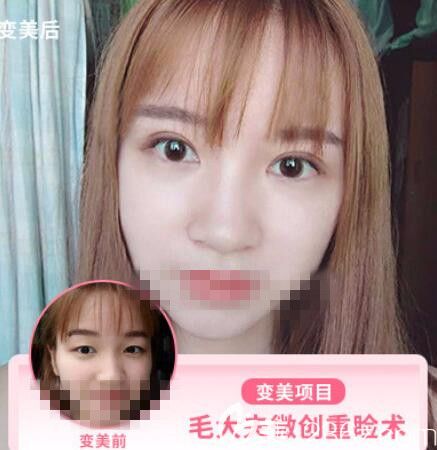 普瀟醫(yī)生做的眼部整形