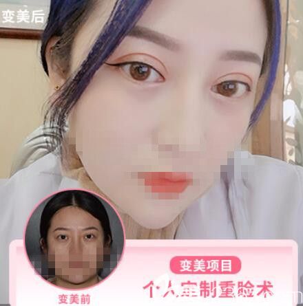 眼部修復(fù)案例