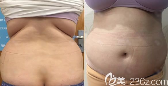 選擇義烏連天美做腰腹吸脂前 選擇義烏連天美做腰腹吸脂前