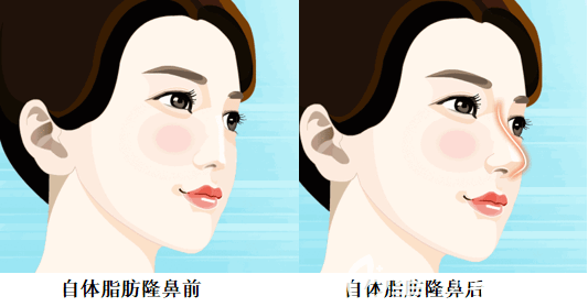 自體脂肪隆鼻前后對比效果圖