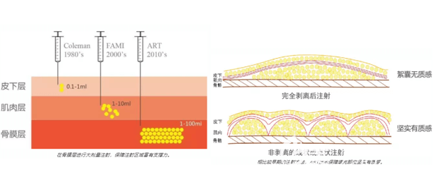 北京上上相ART技術(shù)做自體脂肪隆鼻注射過程示意圖