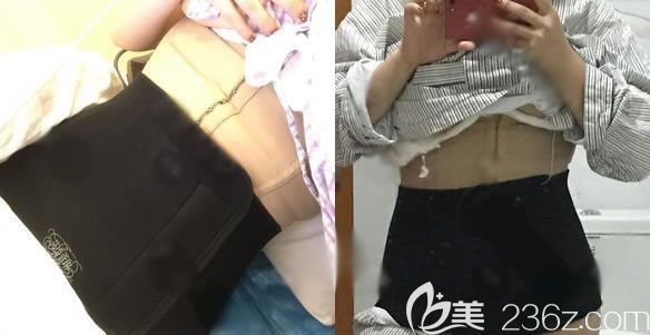 剛做完腰腹部吸脂手術圖片 剛做完腰腹部吸脂手術圖片