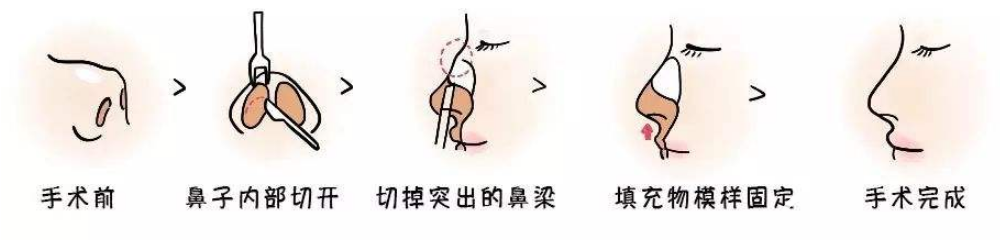 駝峰鼻矯正示意圖 駝峰鼻矯正示意圖