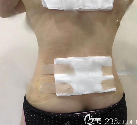 義烏連天美做腰腹吸脂7天后 義烏連天美做腰腹吸脂7天后