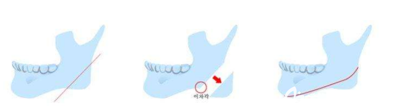 磨骨去下頜角留角好還是不留好 磨骨去下頜角留角好還是不留好