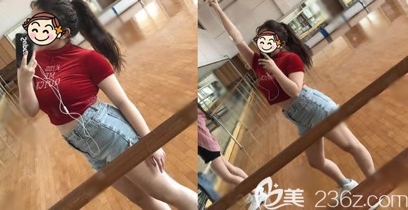 做腰腹部吸脂1個(gè)月就能看到效果了,下面是我在義烏連天美做腰腹環(huán)吸的親身經(jīng)歷