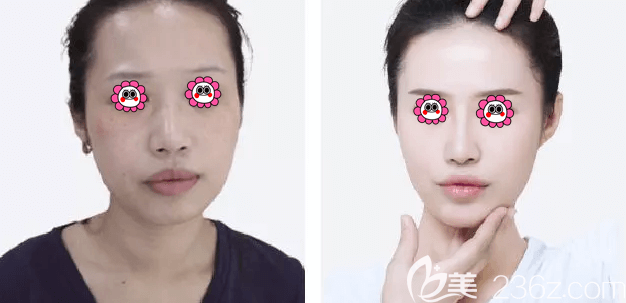 北京藝星baby素白肌案例效果