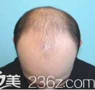 在<!--<i data=20240703-sp></i>-->整形醫(yī)院做植發(fā)前是6級(jí)脂溢性脫發(fā) 在<!--<i data=20240703-sp></i>-->整形醫(yī)院做植發(fā)前是6級(jí)脂溢性脫發(fā)