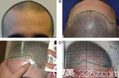 余繼平醫(yī)生為我做植發(fā)前設(shè)計(jì) 余繼平醫(yī)生為我做植發(fā)前設(shè)計(jì)