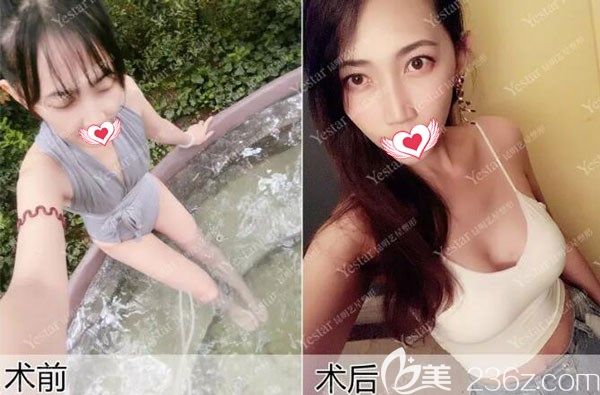 硅膠隆胸三個(gè)月前后效果對比圖