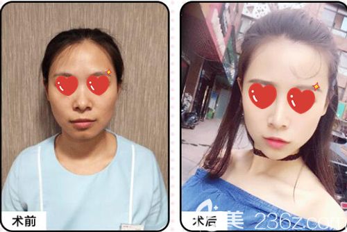 武漢美基元玻尿酸填充豐臉術(shù)前術(shù)后對比效果
