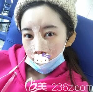 做完自體軟骨隆鼻術(shù)后第4天效果