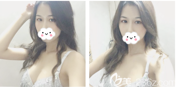 自體脂肪隆胸術(shù)后半個月恢復期圖片