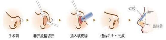 鼻綜合手術(shù)過程示意圖