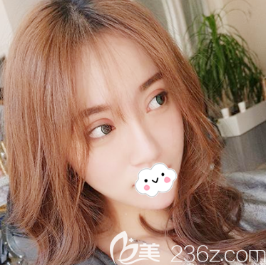 李瑞醫(yī)生雙眼皮隆鼻案例15天恢復(fù)效果圖