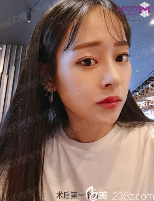 韓國migo姜垠宅硅膠隆鼻+埋線雙眼皮3個月后看看我的變化，自己都吃驚