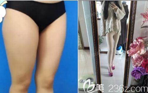 吸脂后穿塑身衣的效果圖