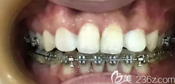 上牙做完牙貼面后的變化圖 上牙做完牙貼面后的變化圖