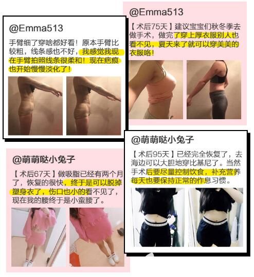 蘇州紫馨吸脂案例 蘇州紫馨吸脂案例