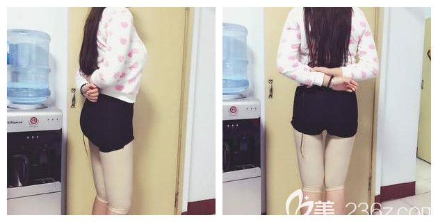 剛做完大腿吸脂術后恢復 剛做完大腿吸脂術后恢復