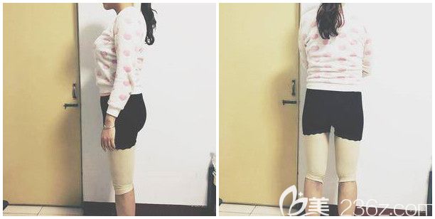 大腿和腿部吸脂一周后穿著塑身衣 大腿和腿部吸脂一周后穿著塑身衣