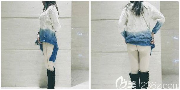 做完大腿吸脂+臀部吸脂術后半個月恢復 做完大腿吸脂+臀部吸脂術后半個月恢復