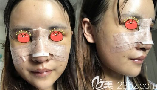 寧波美萊剛做完面部填充和隆鼻圖片