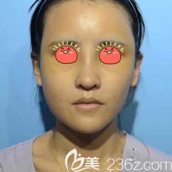 自體脂肪填充和隆鼻一起做7天后