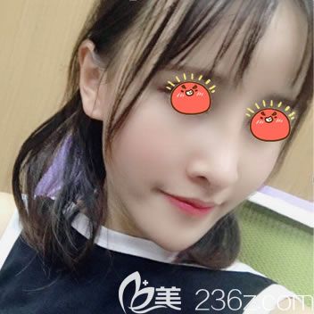 寧波美萊陳富旺脂肪填充和隆鼻案例